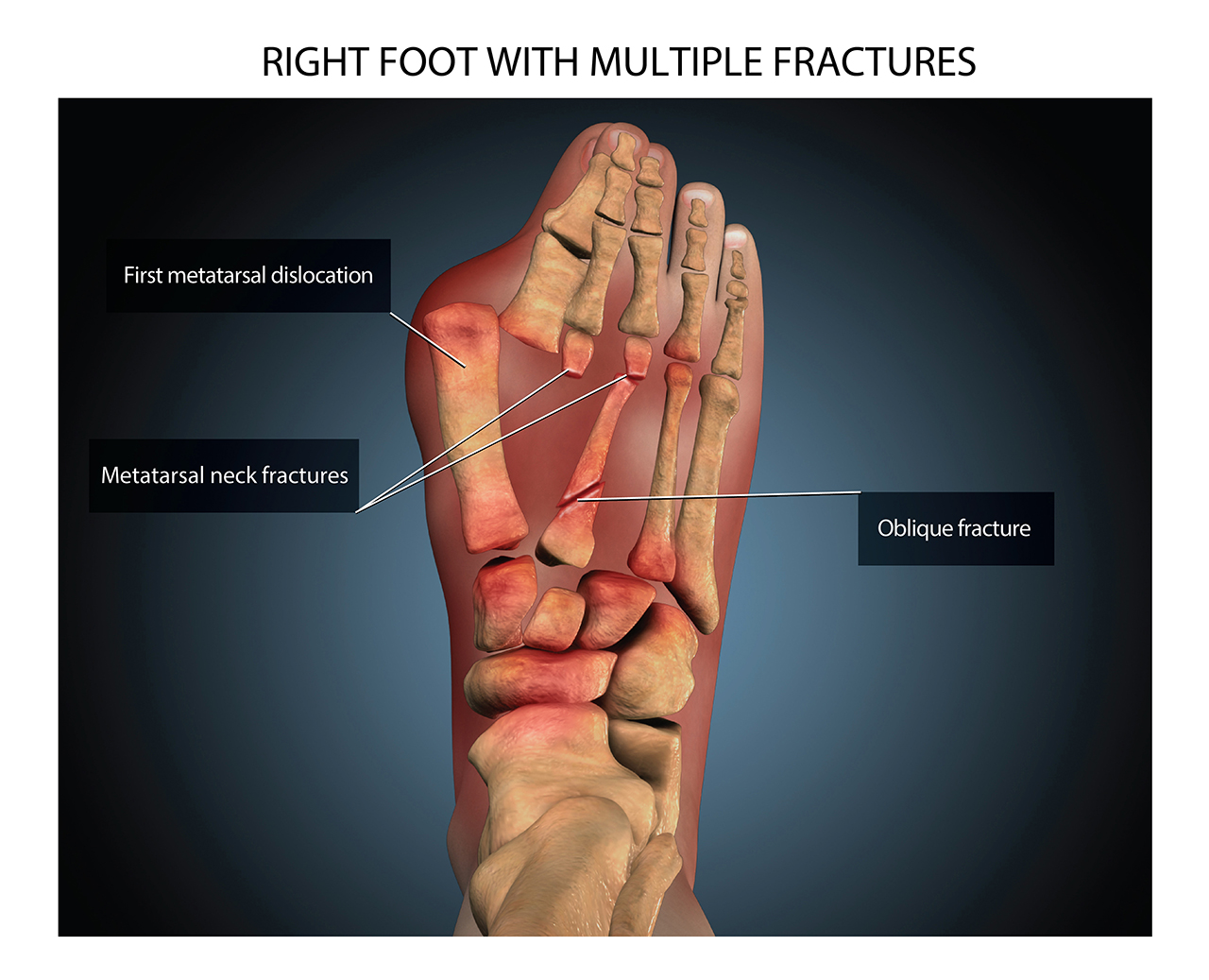 Medical – Right Foot Fractures