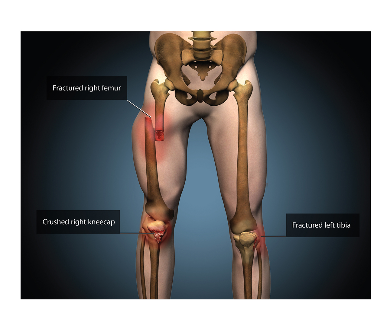 Medical – Upper Leg